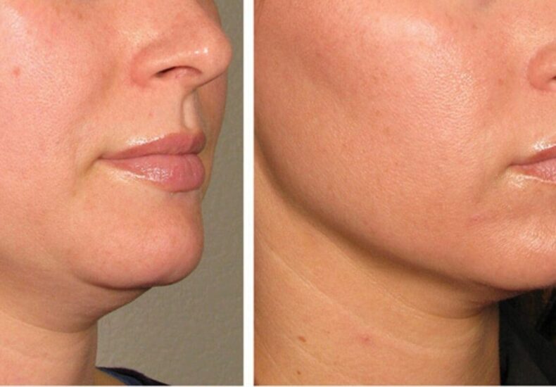 workout leher - ilustrasi berita 4 Workout Leher Mudah untuk Menegaskan Jawline dan Neckline